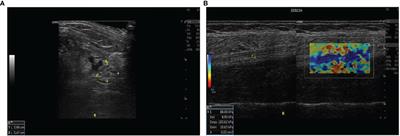 Shear Wave Elastography in the Diagnosis of Peripheral Neuropathy in Patients With Chronic Kidney Disease Stage 5